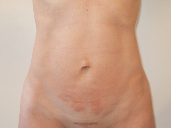 mini tummy tuck patient