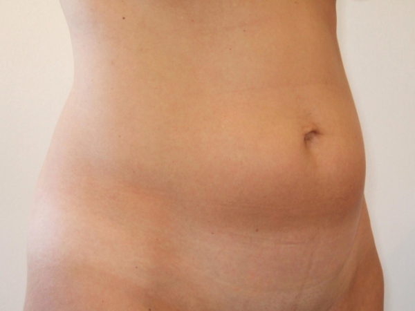 mini tummy tuck patient