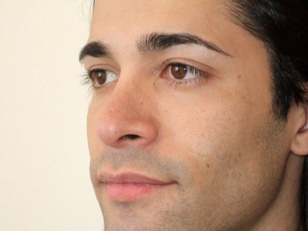 rhinoplasty patient