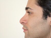 rhinoplasty patient