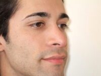 rhinoplasty patient