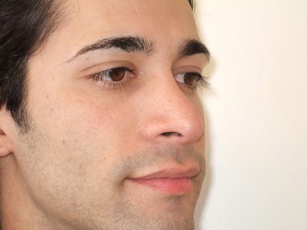 rhinoplasty patient