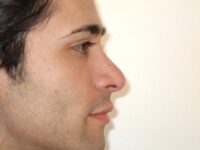 rhinoplasty patient