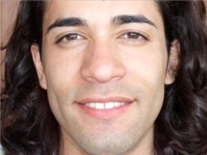 rhinoplasty patient