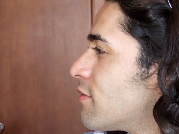 rhinoplasty patient