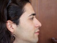 rhinoplasty patient