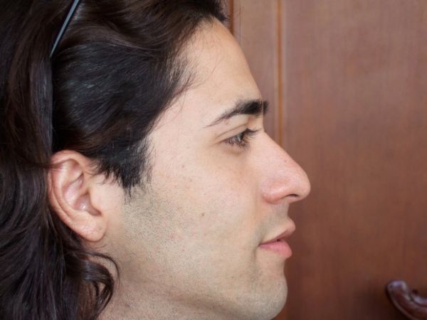 rhinoplasty patient