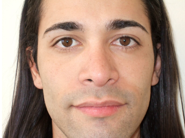 rhinoplasty patient