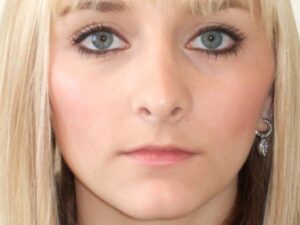 rhinoplasty patient