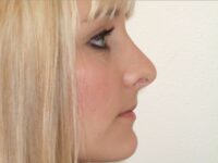 rhinoplasty patient