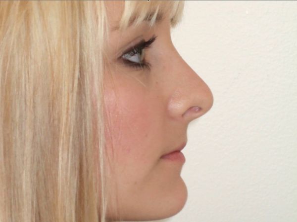 rhinoplasty patient