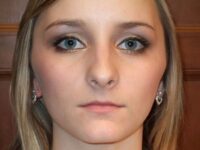 rhinoplasty patient