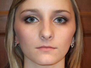 rhinoplasty patient