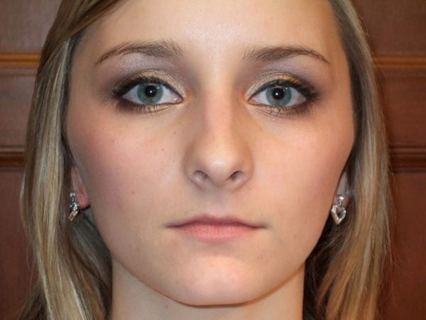 rhinoplasty patient