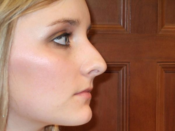 rhinoplasty patient