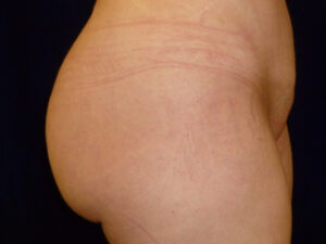 brazilian butt lift patient