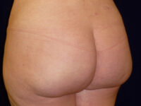 brazilian butt lift patient