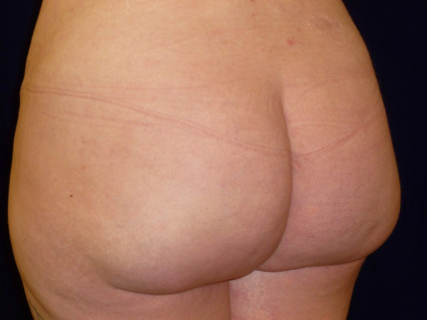 brazilian butt lift patient