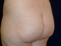 brazilian butt lift patient