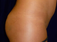 brazilian butt lift patient