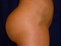 brazilian butt lift patient