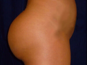 brazilian butt lift patient