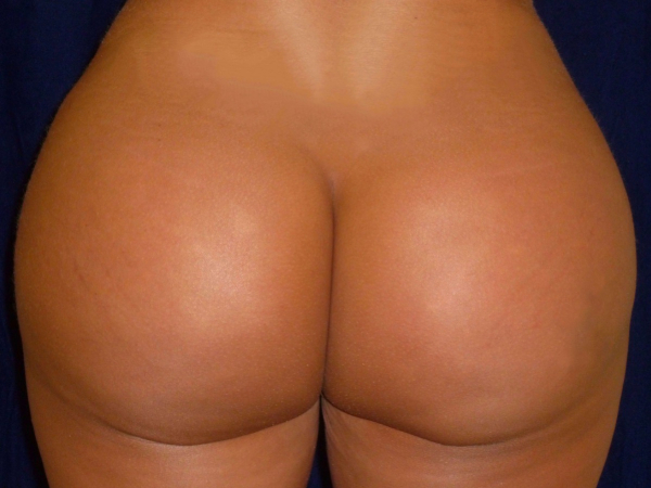 brazilian butt lift patient