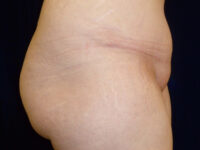 brazilian butt lift patient