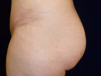 brazilian butt lift patient