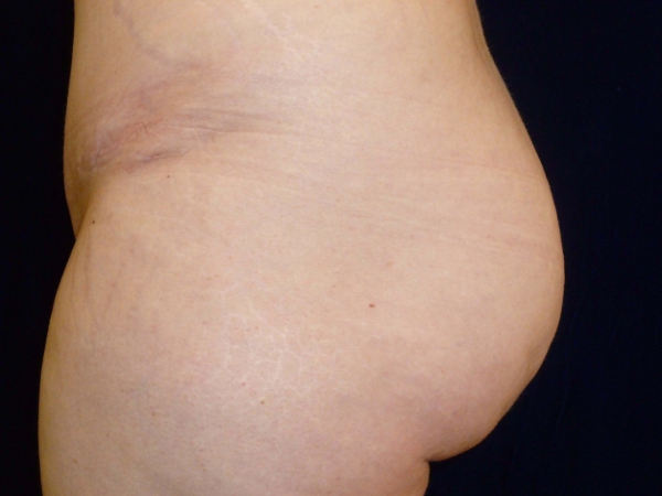 brazilian butt lift patient