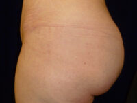 brazilian butt lift patient