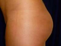 brazilian butt lift patient