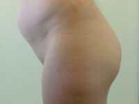 brazilian butt lift patient