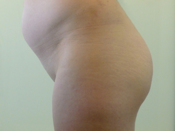 brazilian butt lift patient