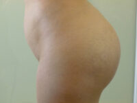 brazilian butt lift patient