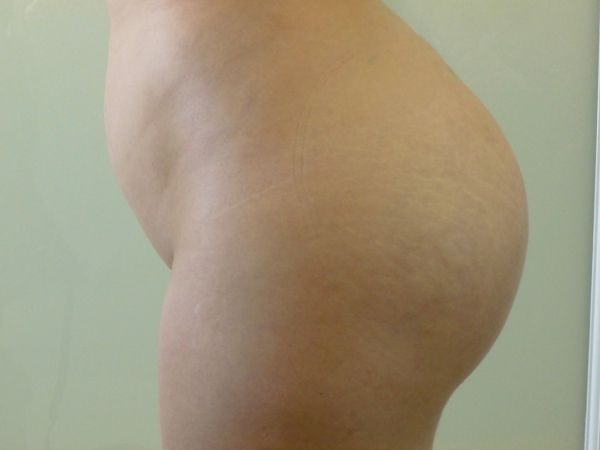 brazilian butt lift patient