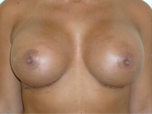 after breast augmentation front view of female patient 2315