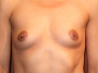 before breast augmentation front view of female patient 1912