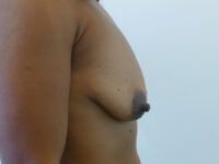 before breast augmentation right side view of female patient 1944