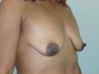 before breast augmentation right angle view of female patient 1944