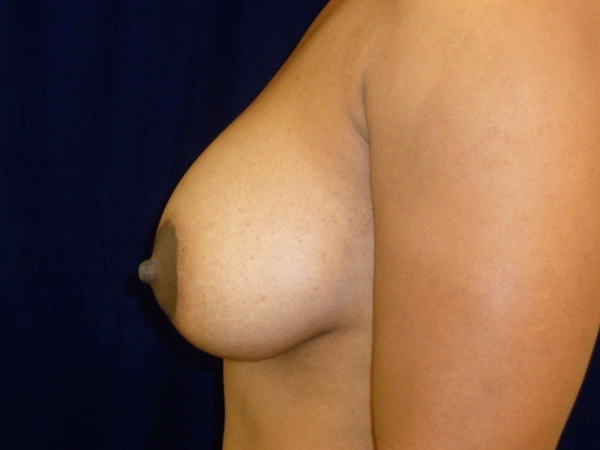 after breast augmentation left side view of female patient 1944