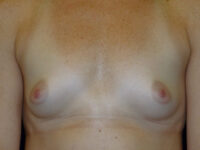 before breast augmentation front view of female patient 1999