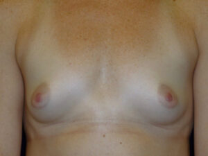 before breast augmentation front view of female patient 1999