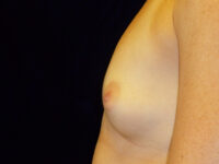 before breast augmentation left side view of female patient 1999