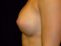 after breast augmentation left side view of female patient 1999