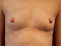 before breast augmentation front view of female patient 2031