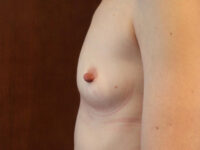 before breast augmentation left side view of female patient 2031