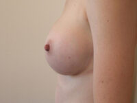 after breast augmentation left side view of female patient 2031