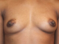 after breast augmentation front view of female patient 2042
