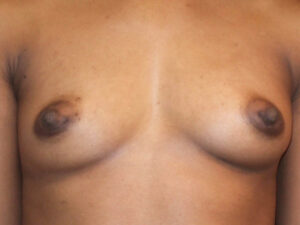 after breast augmentation front view of female patient 2042